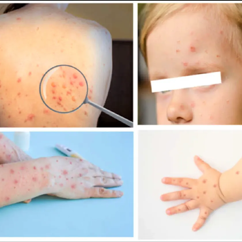 Monkeypox effects on Humans
